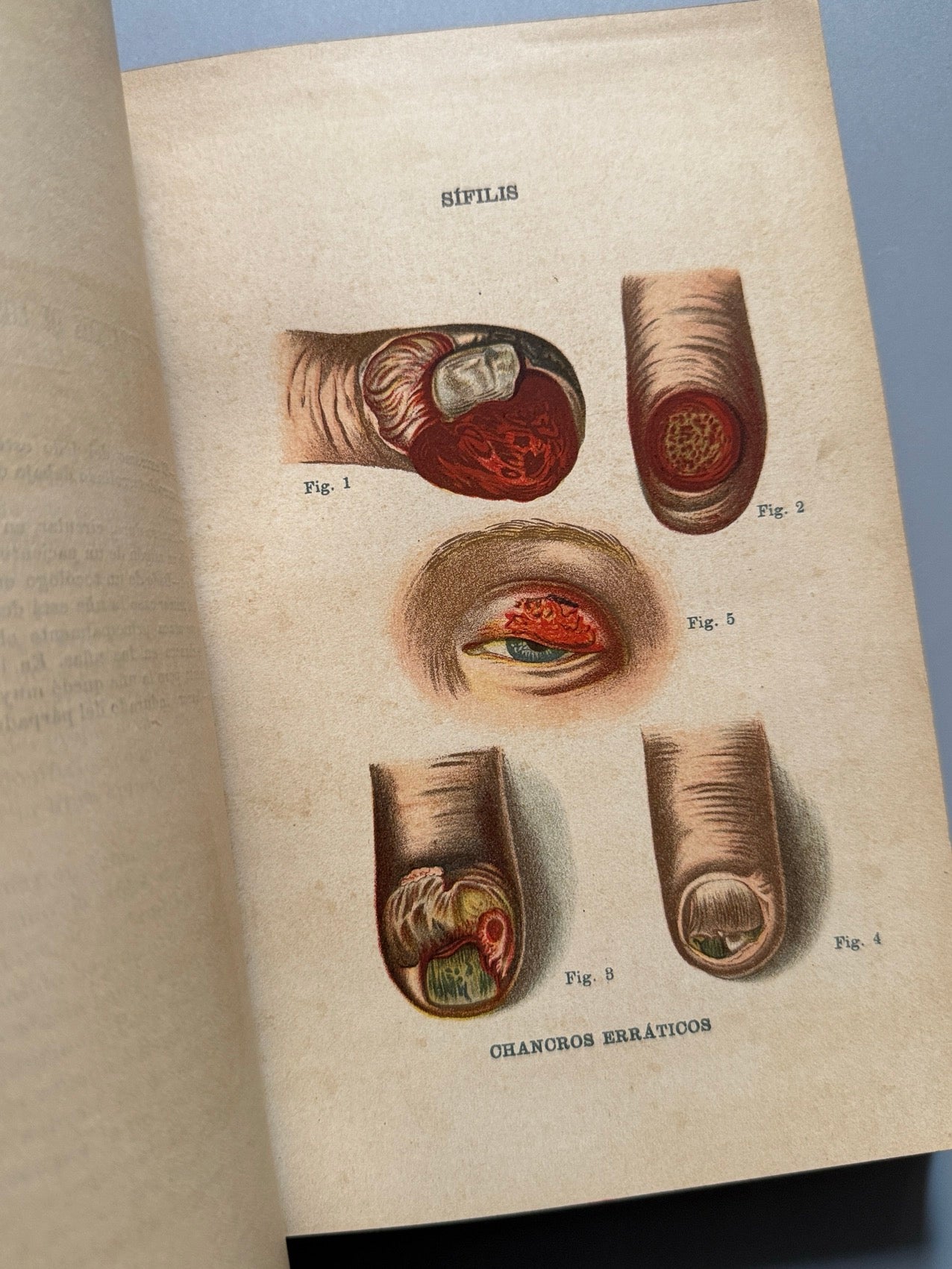 Libro de: La sífilis, Jonathas Hutchinson - Editorial de Ramón Molinas, 1888